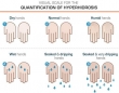 Hyperhidrosis-Treatment